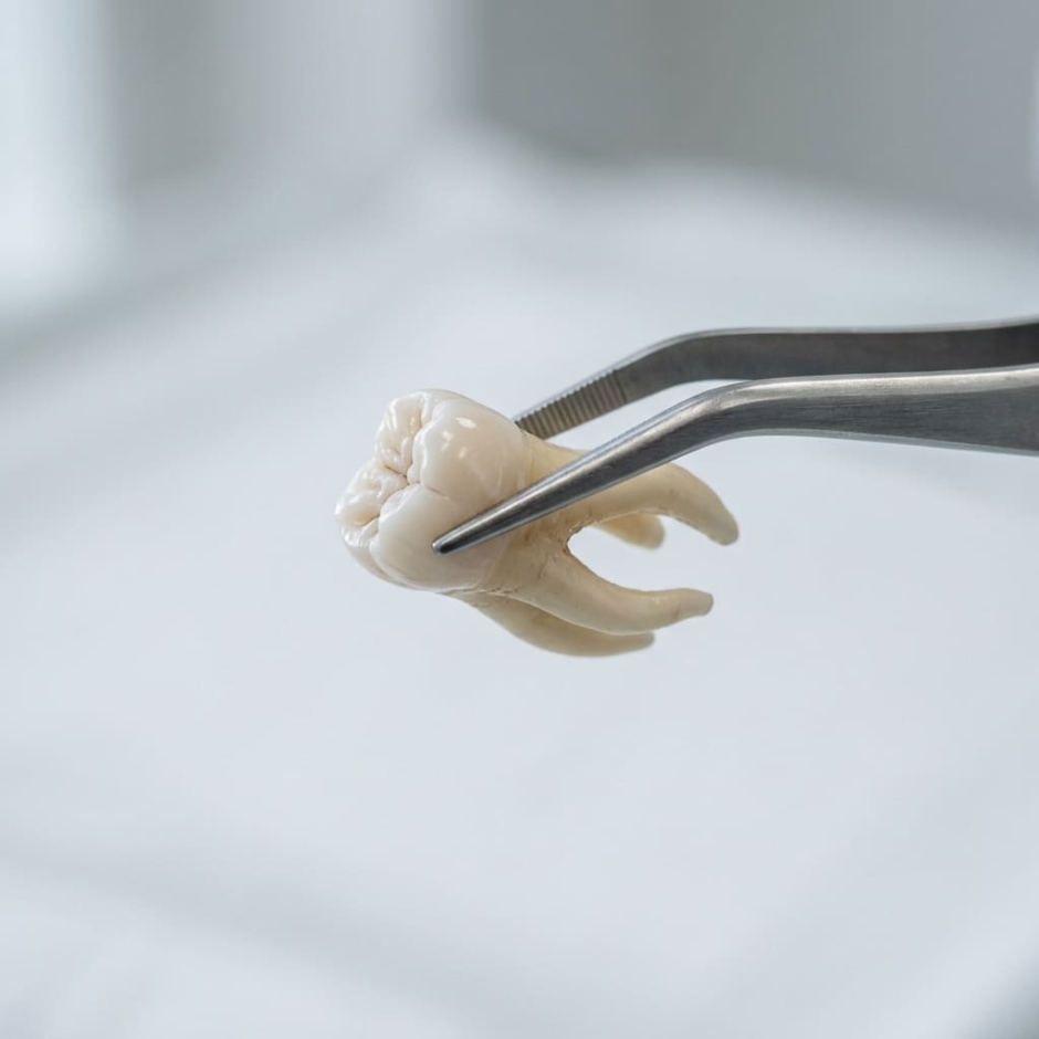 Удаление зуба мудрости Кишинев: больно ли и как проходит процесс?