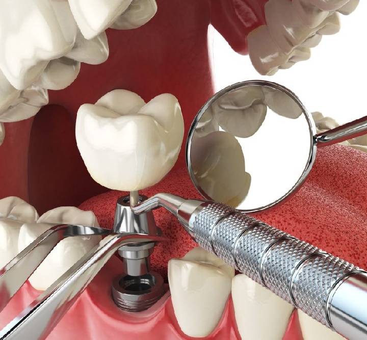 implant dentar chisinau